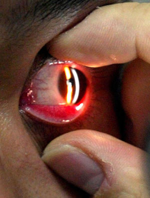 急性出血性结膜炎