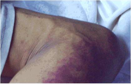 人猪重症链球菌感染